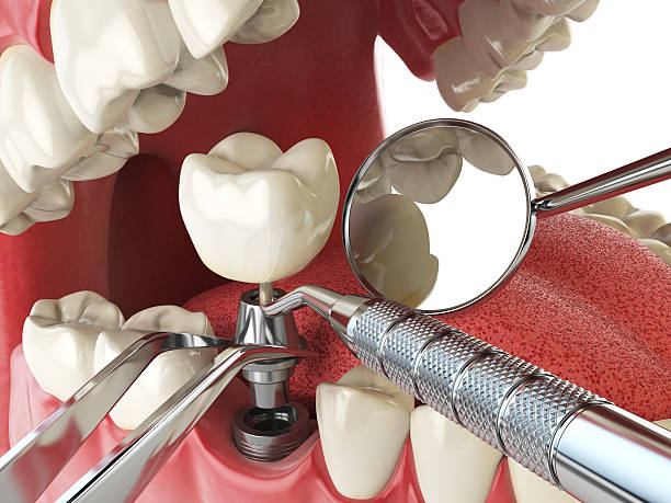 Best Emergency Treatment for Toothache in Santa Fe, NM